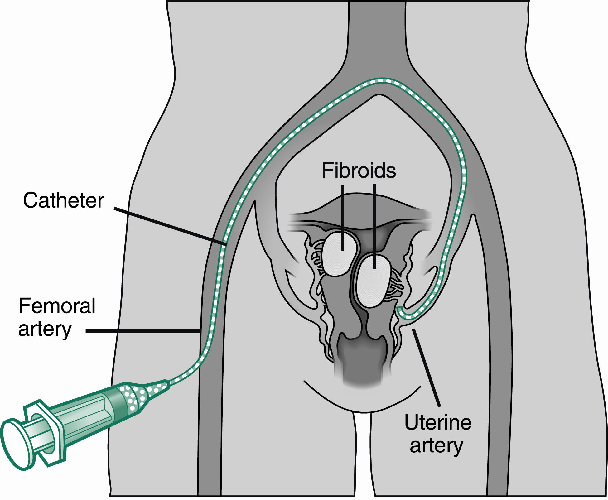 миома матки операция
