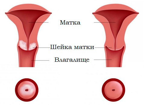 Лейкоплакия шейки матки