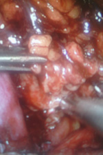 Тазовая лимфаденэктомия