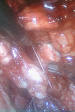 Рак шейки матки, лечение. Тазовая лимфаденэктомия