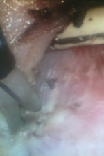 Операции рака шейки матки. Низведение мочевого пузыря