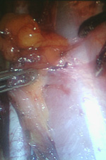 Операции рака шейки матки. Тазовая лимфаденэктомия