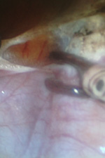 Рак шейки матки, лечение. Коагуляция и пересечение связочного аппарата