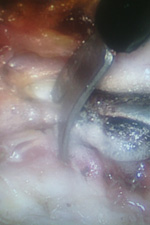 Операции рака шейки матки. Коагуляция и пересечение маточных сосудов