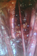 Операции рака шейки матки. Регионарные лимфоузлы удалены