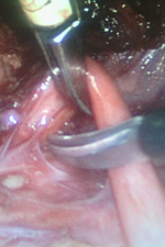 Операции рака шейки матки. Выделение мочеточников