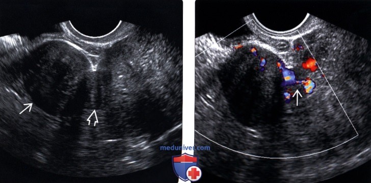 Методы обследования лейомиомы