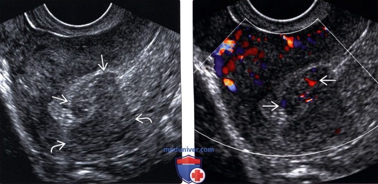 Методы обследования лейомиомы