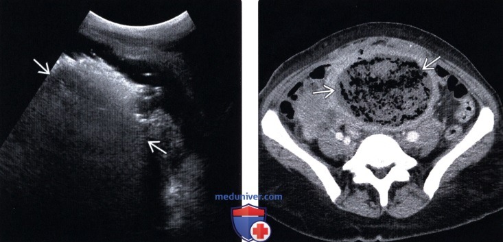 Методы обследования лейомиомы