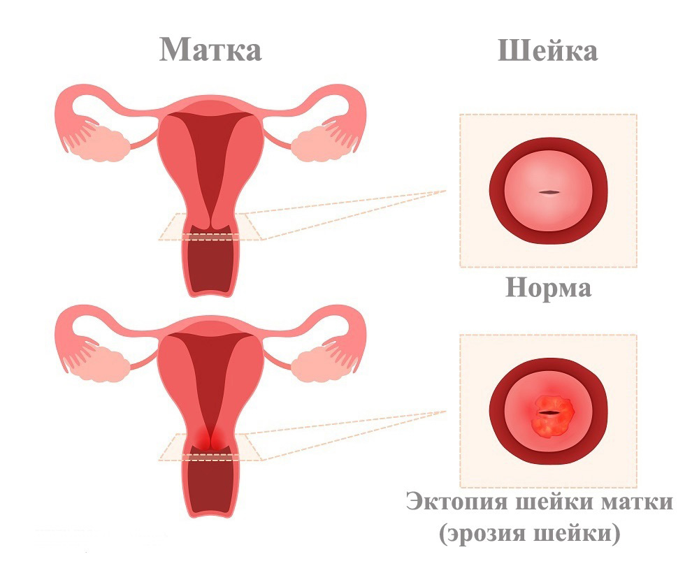 эктопия шейки матки