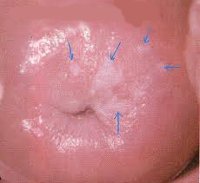 Лейкоплакия шейки матки