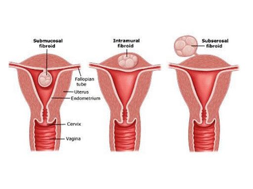 Миома матки