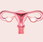 Миома матки и гиперплазия эндометрия