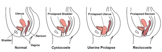 пролапс гениталий
