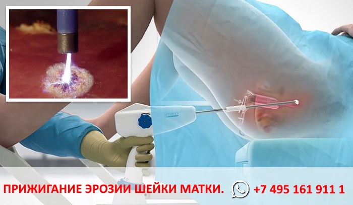 Прижигание эрозии шейки матки в Москве. Тел. +7 495 161 911 1