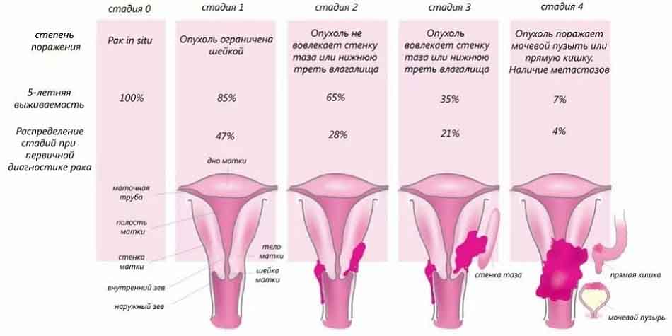 Стадии развития цервикального рака от 0 до 4