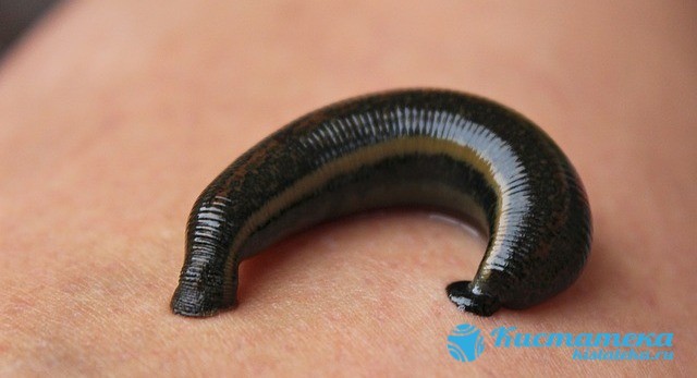 Лечение кист шейки матки народными средствами: рецепты