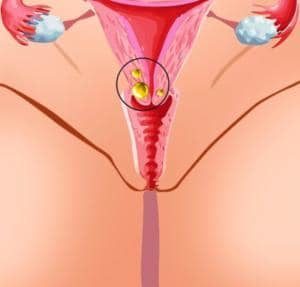 Лечение кист шейки матки народными средствами: рецепты