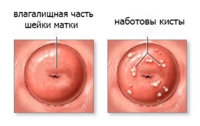 Лечение кист шейки матки народными средствами: рецепты