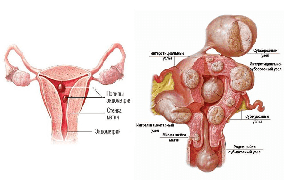 Лечение фиброзного полипа шейки матки
