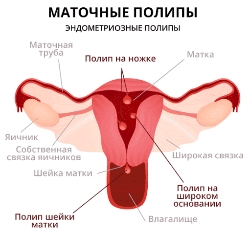 Фиброзный полип шейки матки