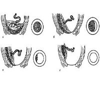 Шеечная беременность