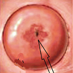 Патология шейки матки