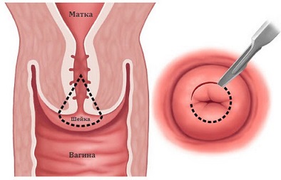 Обширная биопсия шейки матки