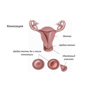 Конизация шейки матки фото