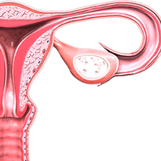 Лейомиома матки