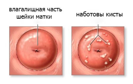 наботовы кисты