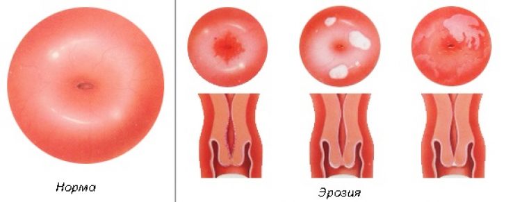 Здоровая шейка и эрозия
