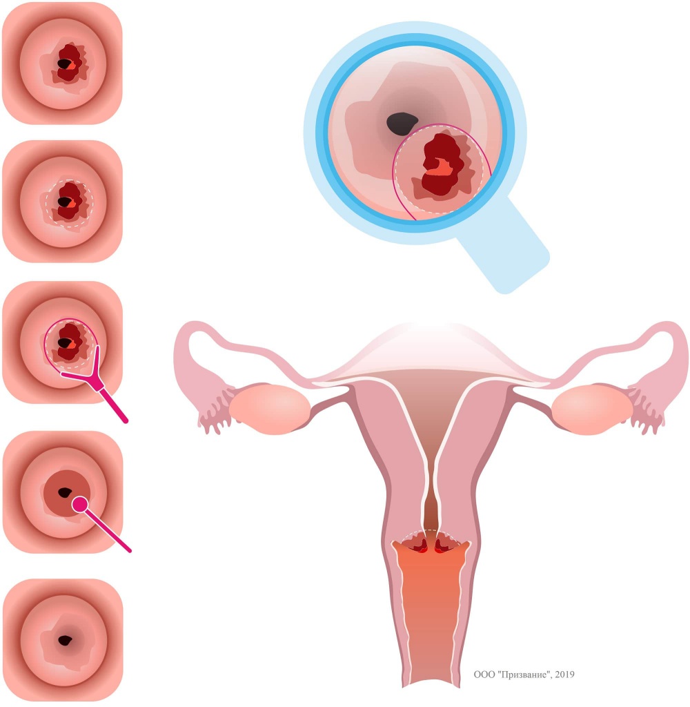 лечение эрозии Самара
