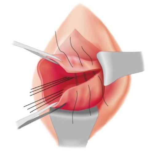 Последствия при разрыве шейки матки при родах: как исправить