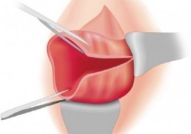 Последствия при разрыве шейки матки при родах: как исправить