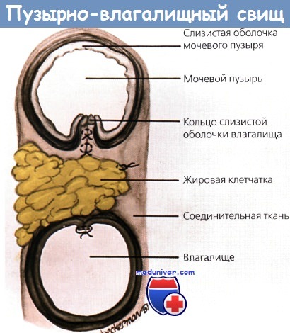 Пузырно-влагалищные свищи