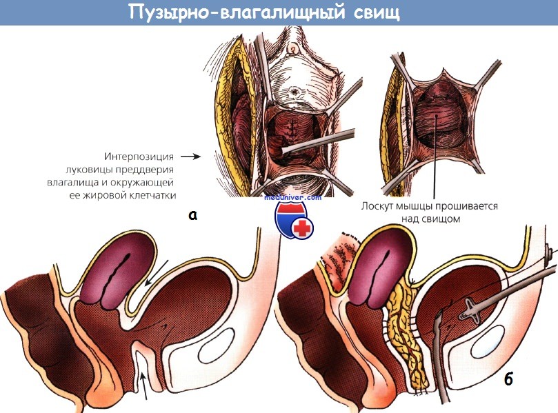 Пузырно-влагалищные свищи