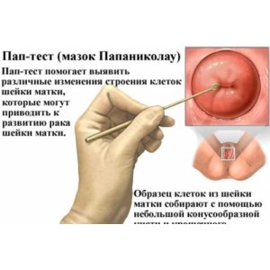 Цитология шейки матки фото
