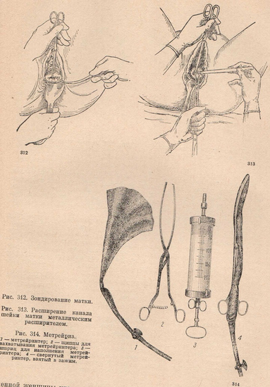 Расширение канала шейки матки металлическим расширителем