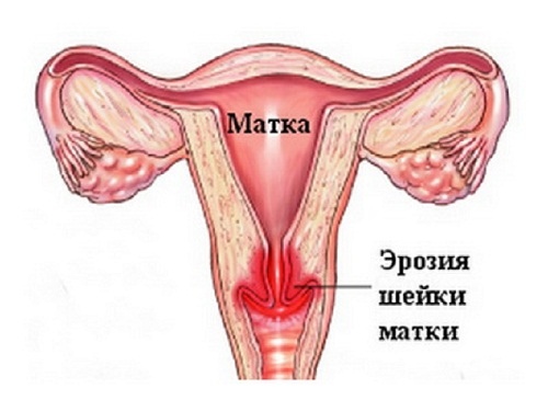 Эрозия шейки матки