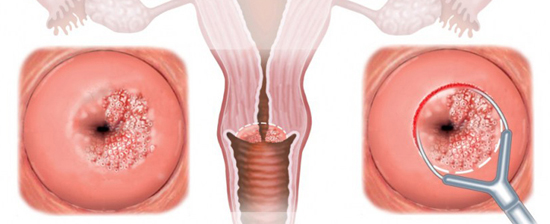 Биопсия матки с помощью сургитрона