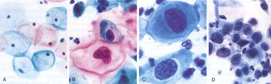 цитология рака шейки матки