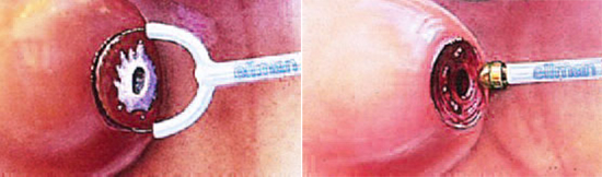 лечение рака шейки матки