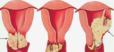 Рак шейки матки