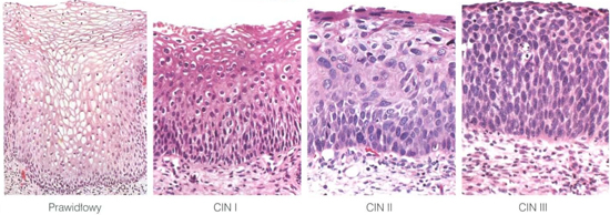 предрак шейки матки