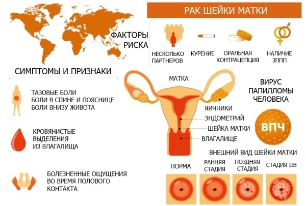 7 ПРИЗНАКОВ РАКА ШЕЙКИ МАТКИ