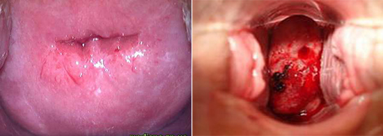 На фото дисплазия и РШМ 