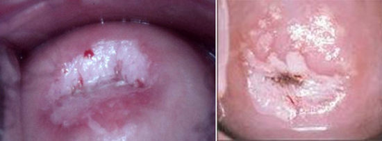 тесты на рак шейки матки