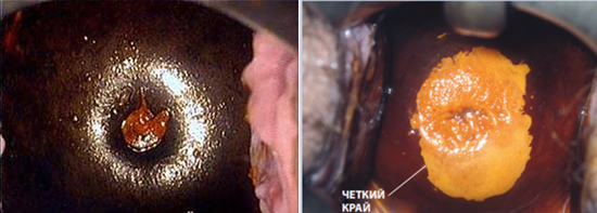 Рейка матки и проба Шиллера