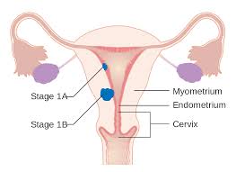 стадии саркомы